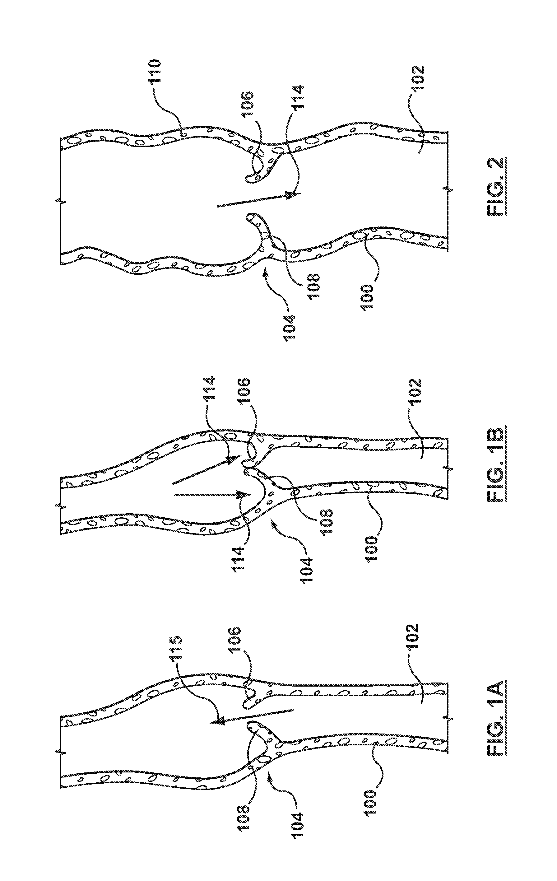 Percutaneous Methods and Apparatus for Creating Native Tissue Venous Valves