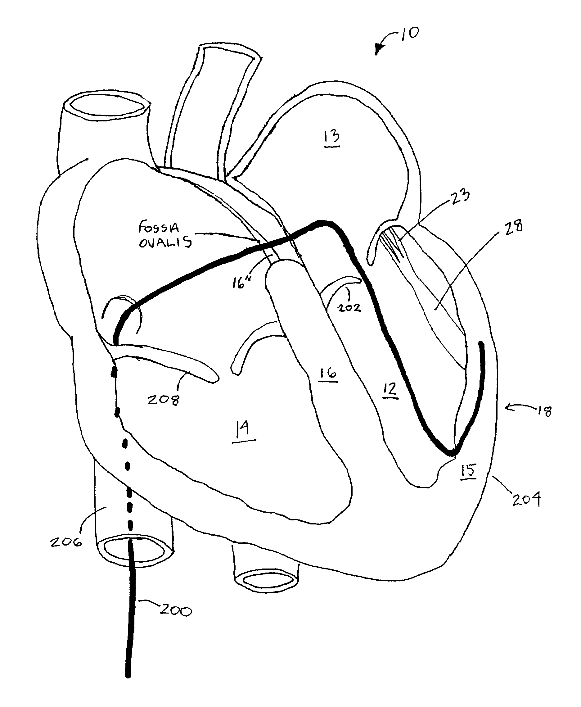 Prevention of myocardial infarction induced ventricular expansion and remodeling