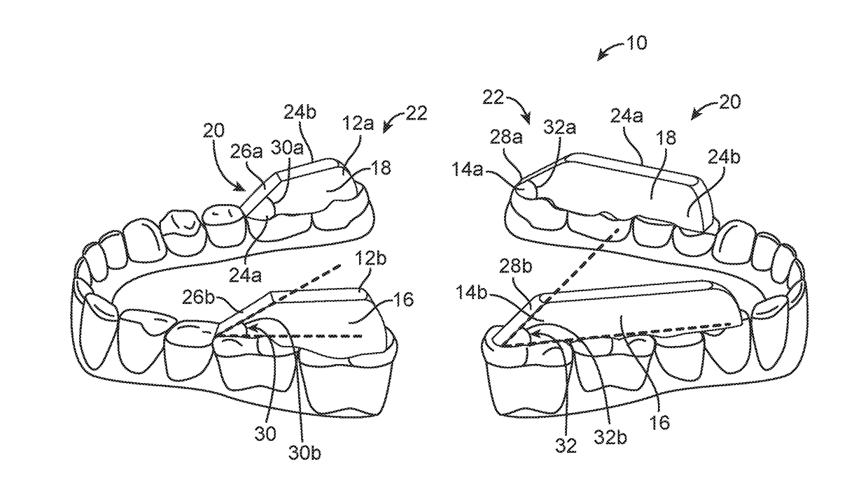 Combined orthodontic movement of teeth with airway development therapy