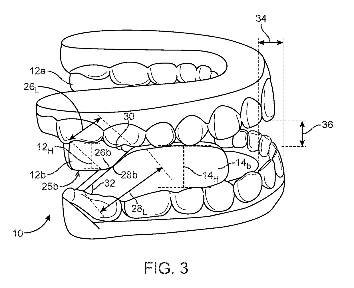 Combined orthodontic movement of teeth with airway development therapy