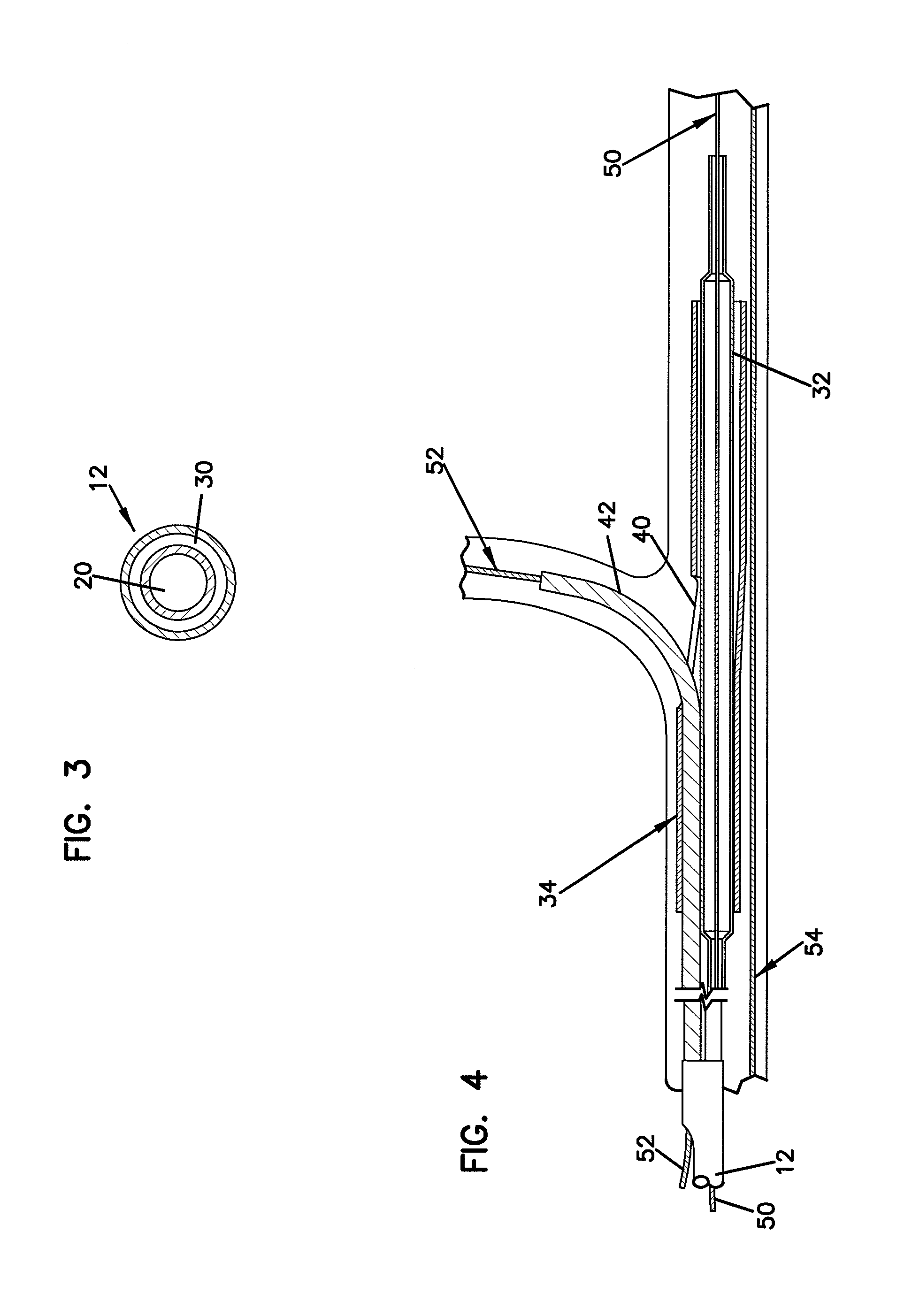 Short sleeve stent delivery catheter and methods