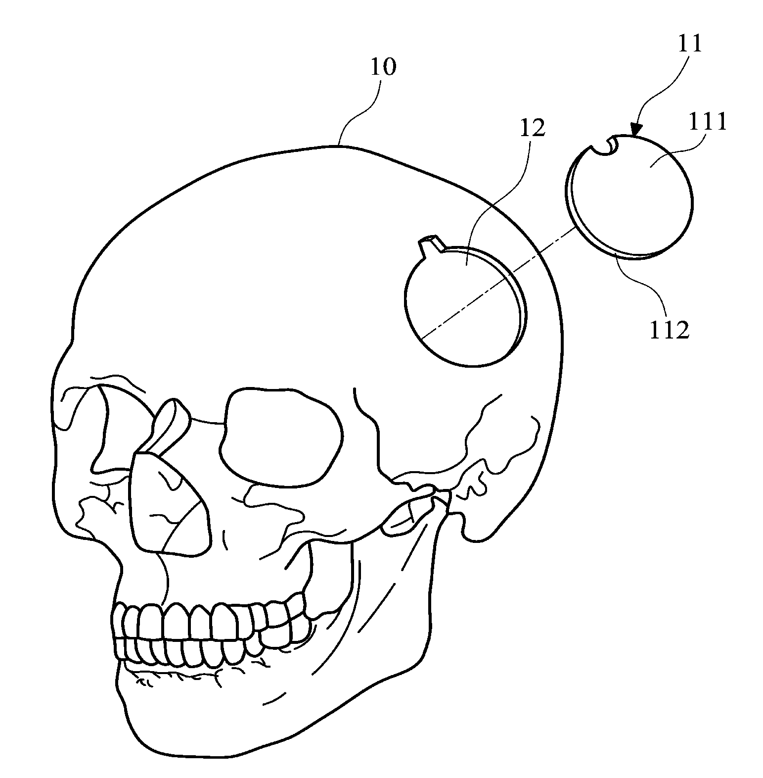 Artificial dura biomedical device and brain surgery method utilizing the same