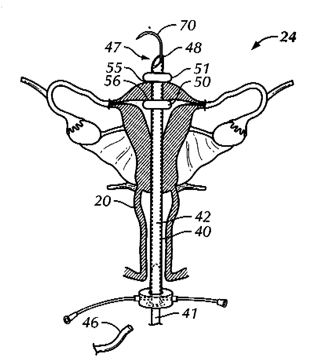Methods and Apparatus for Natural Orifice Vaginal Hysterectomy