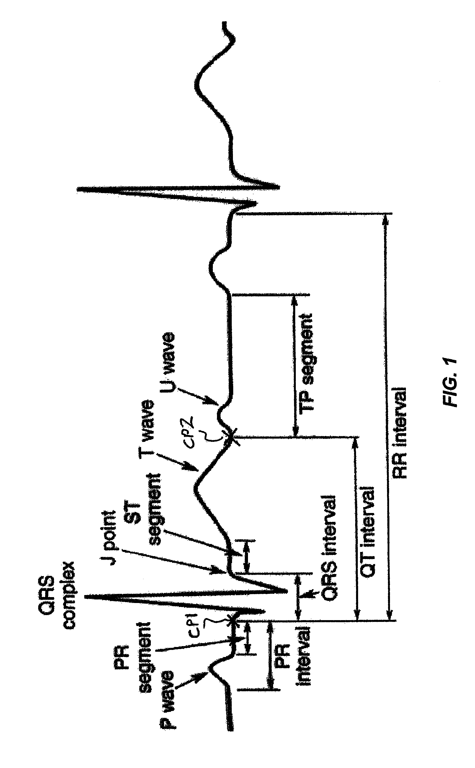 Method and apparatus for rapid interpretive analysis of electrocardiographic waveforms