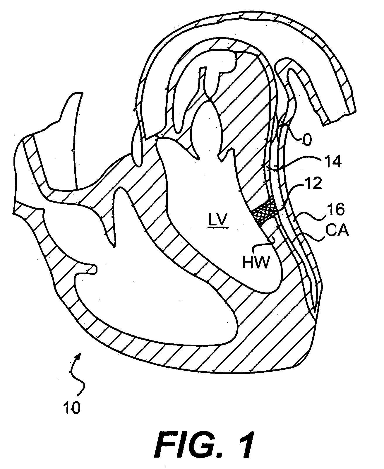 Methods and devices for delivering a ventricular stent