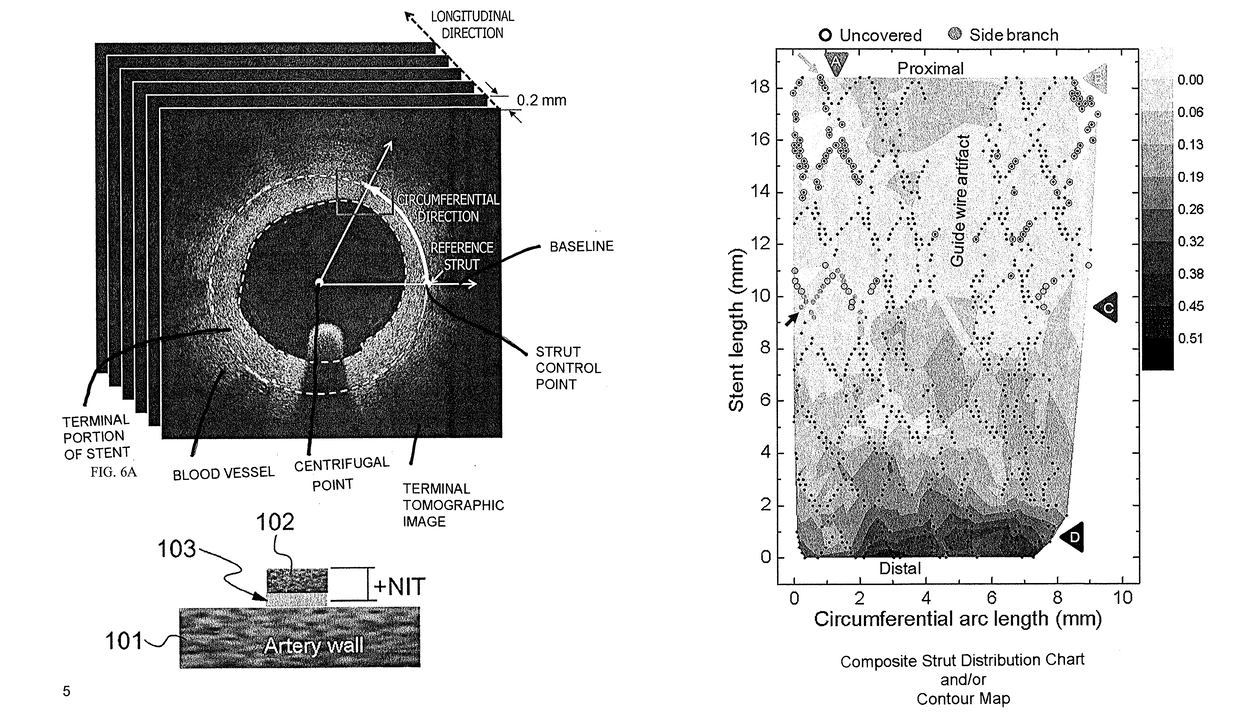 System and method for determining neointima thickness of a blood vessel