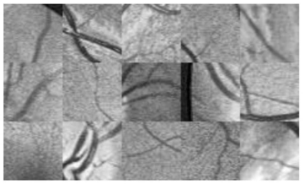 Retinal Vessel Segmentation Method Fused with w-net and Conditional Generative Adversarial Network