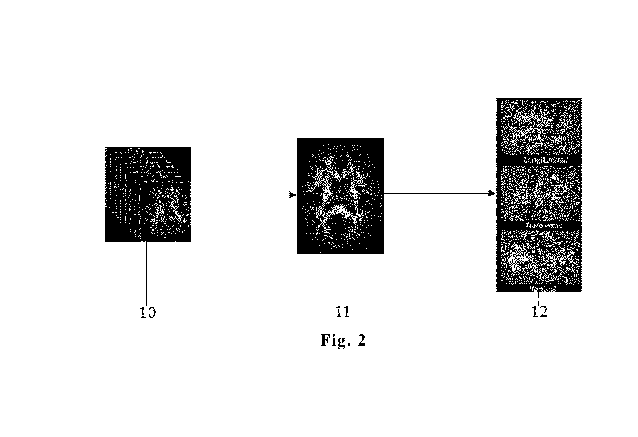 Method of Automatically Analyzing Brain Fiber Tracts Information