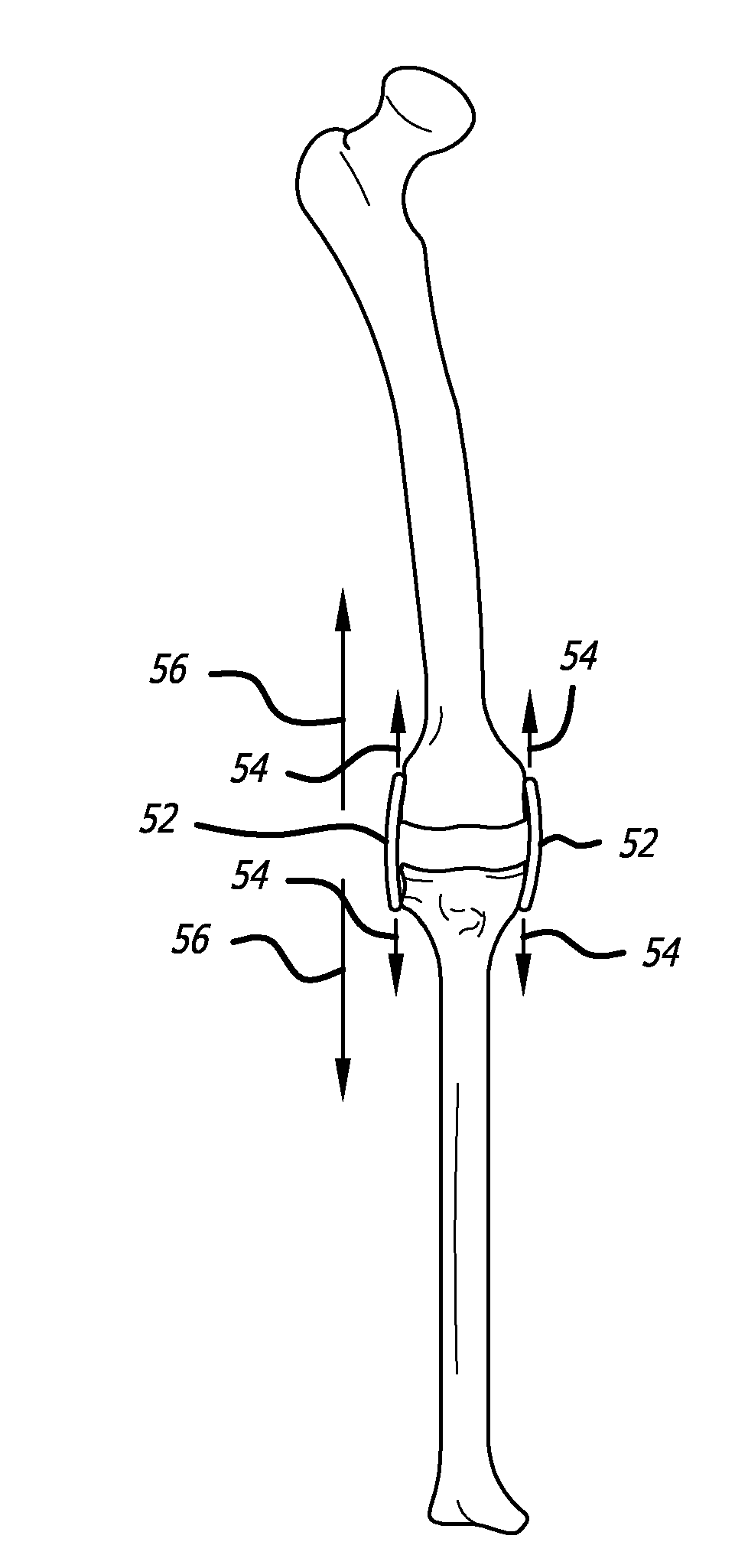 Extra-articular implantable mechanical energy absorbing systems and implantation method
