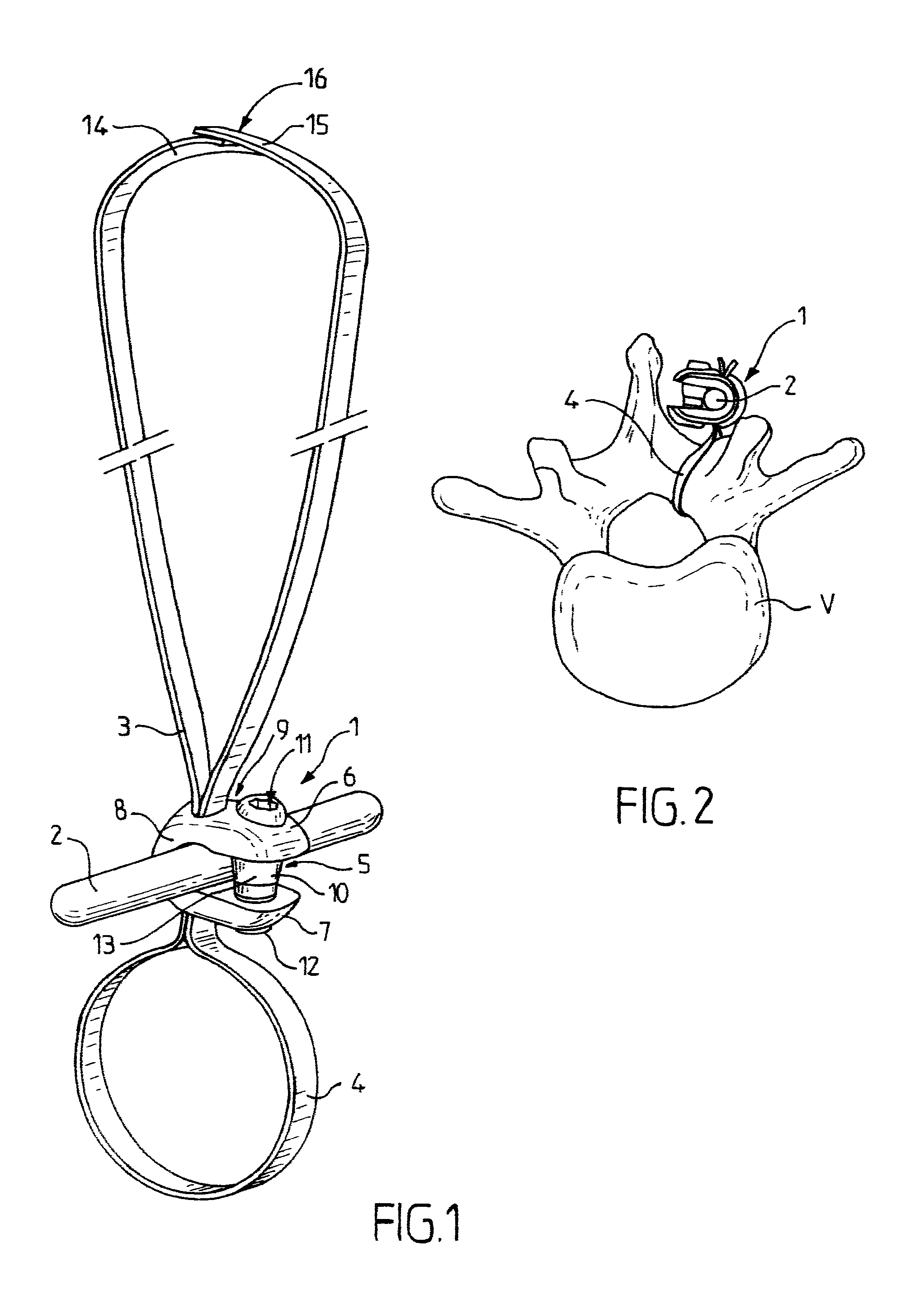 Device for tensioning a flexible band
