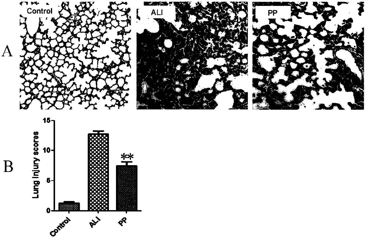 Application of placenta multipotential stem cell preparation in preparation of medicine for treatment of acute lung injury