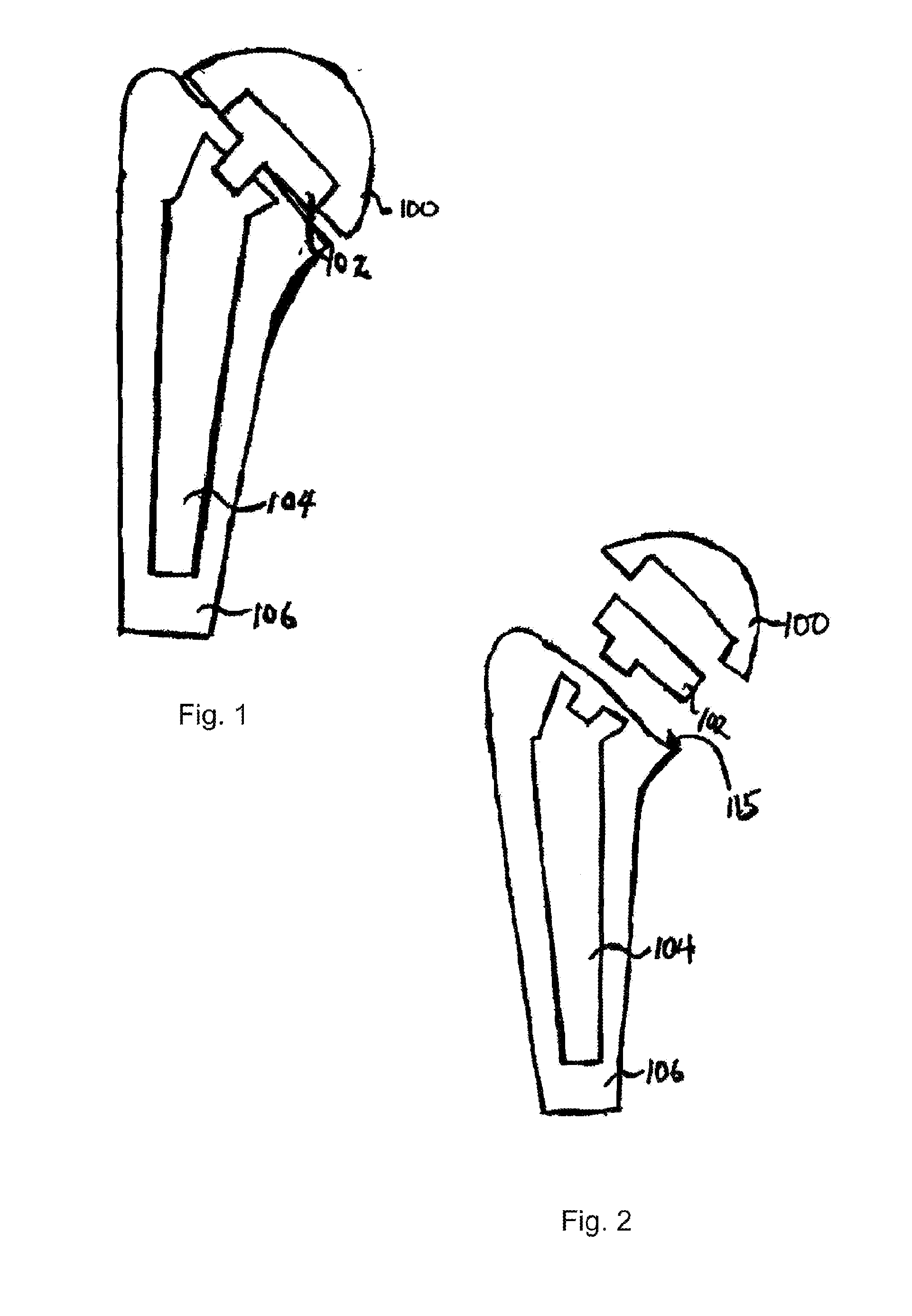 Humeral joint replacement component