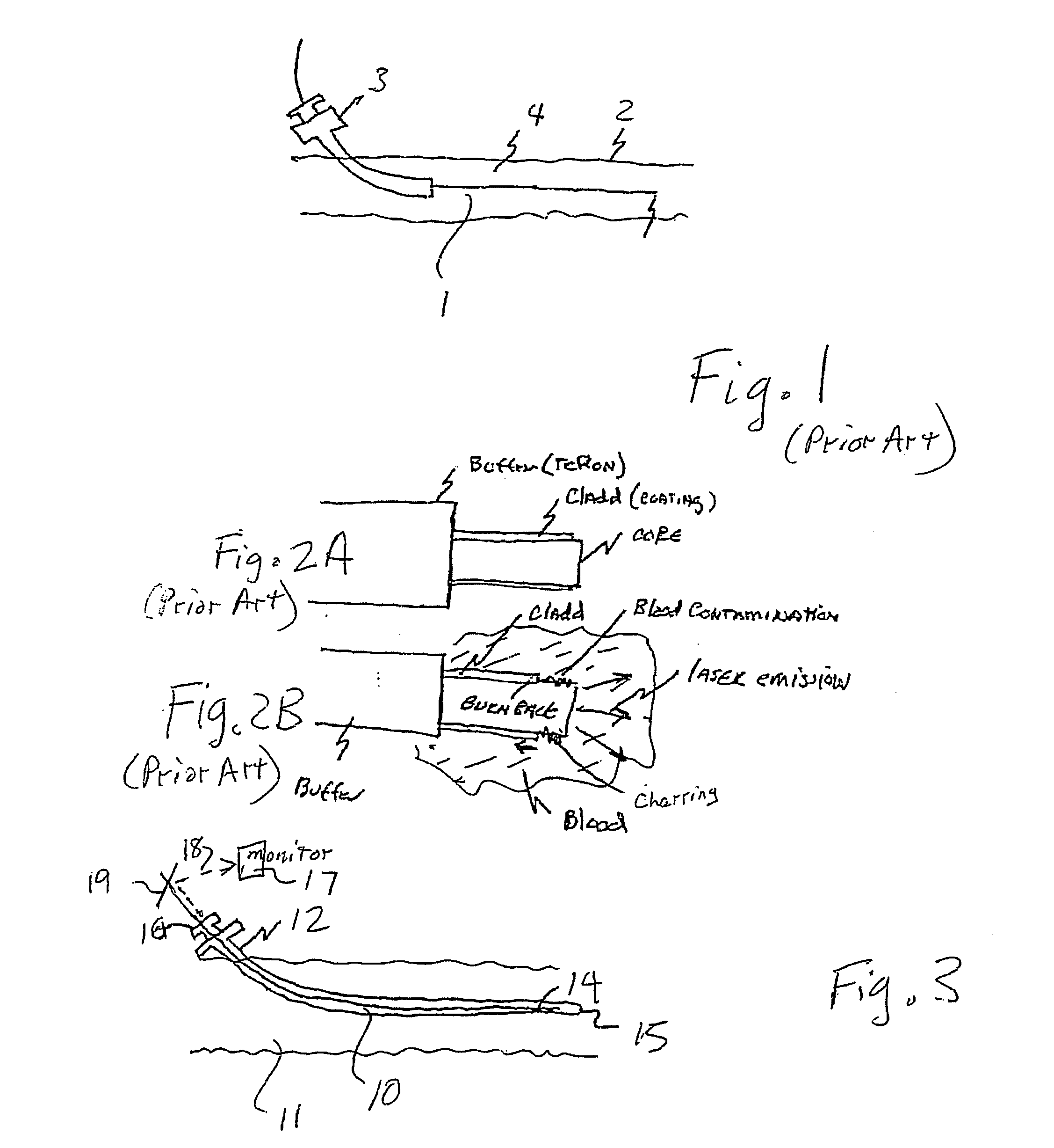 Endovascular method and apparatus with feedback