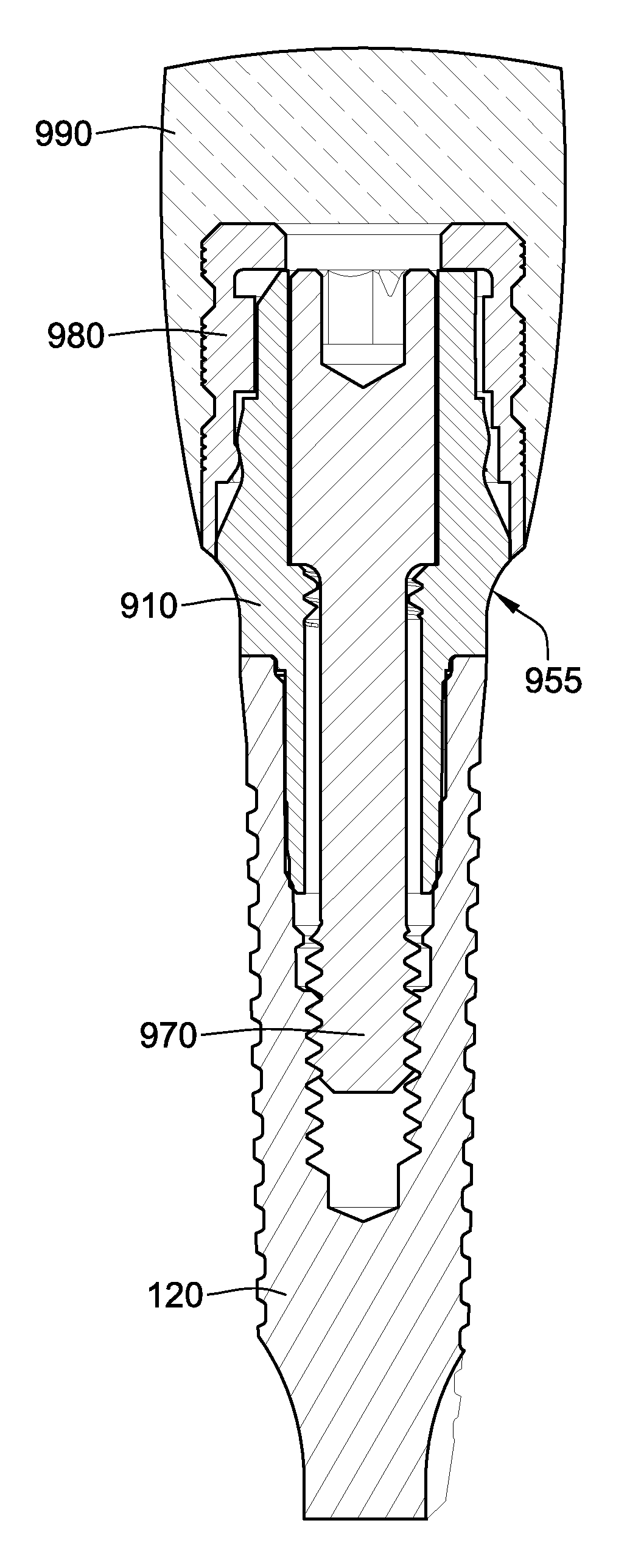 Temporary abutment with combination of scanning features and provisionalization features