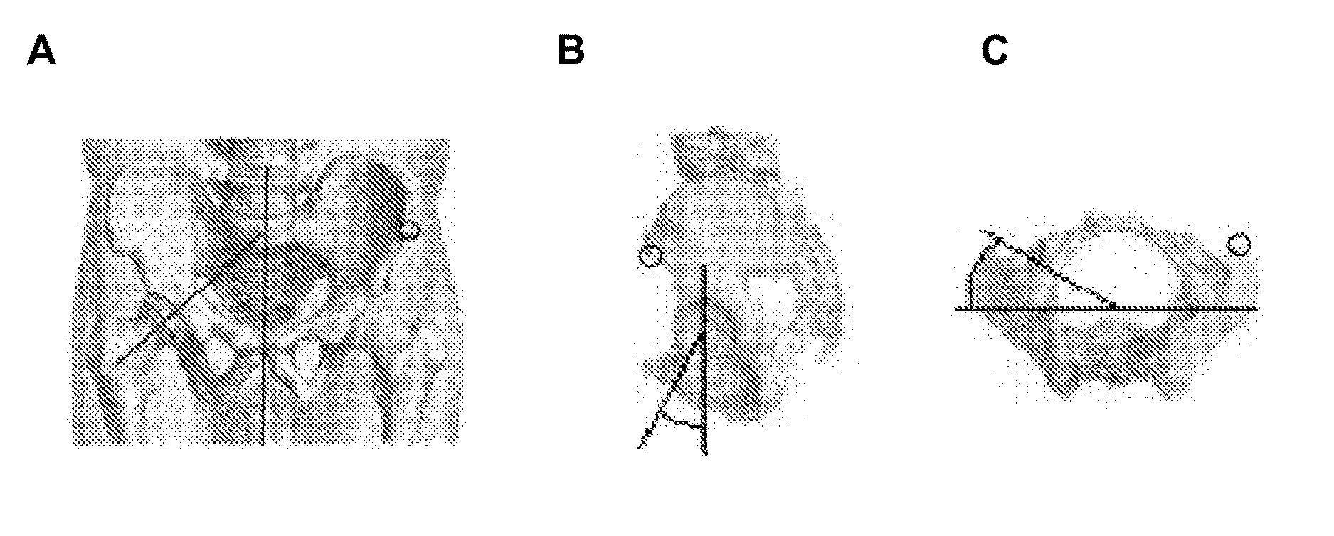 System and method for precise prosthesis positioning in hip arthroplasty