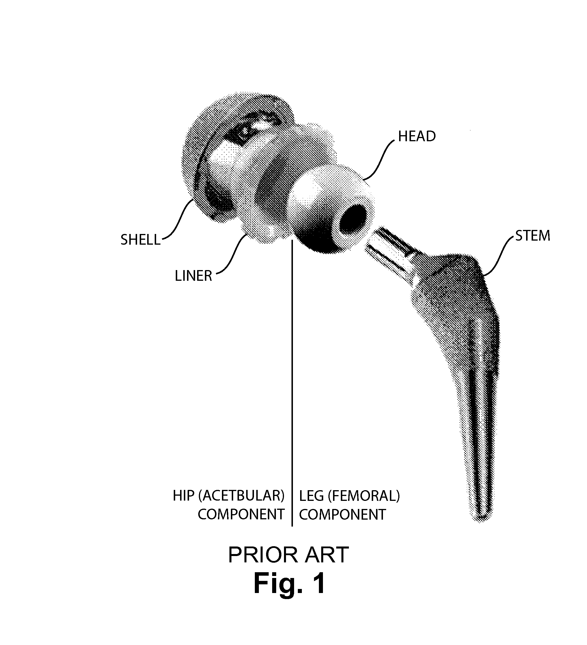 System and method for precise prosthesis positioning in hip arthroplasty