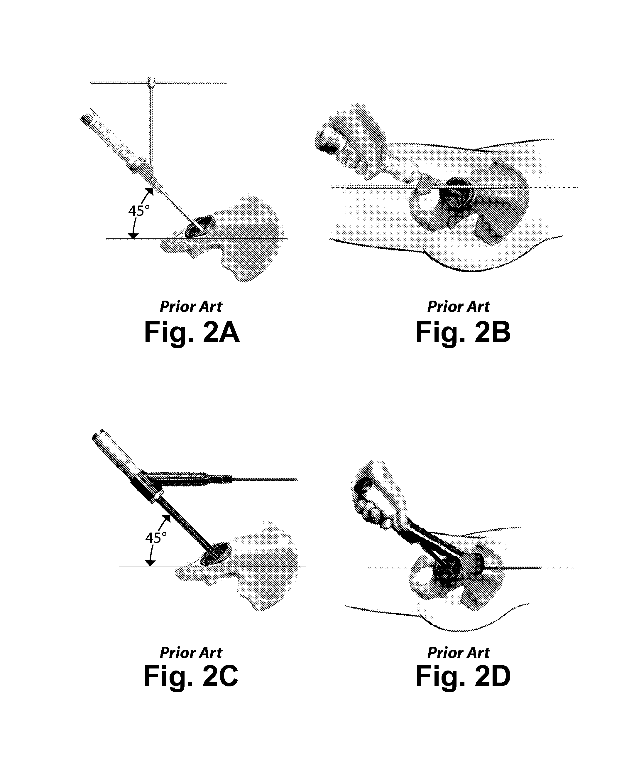 System and method for precise prosthesis positioning in hip arthroplasty