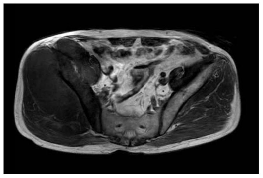 Pelvic bone tumor automatic segmentation and three-dimensional reconstruction method based on multi-modal image