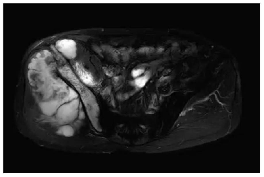 Pelvic bone tumor automatic segmentation and three-dimensional reconstruction method based on multi-modal image