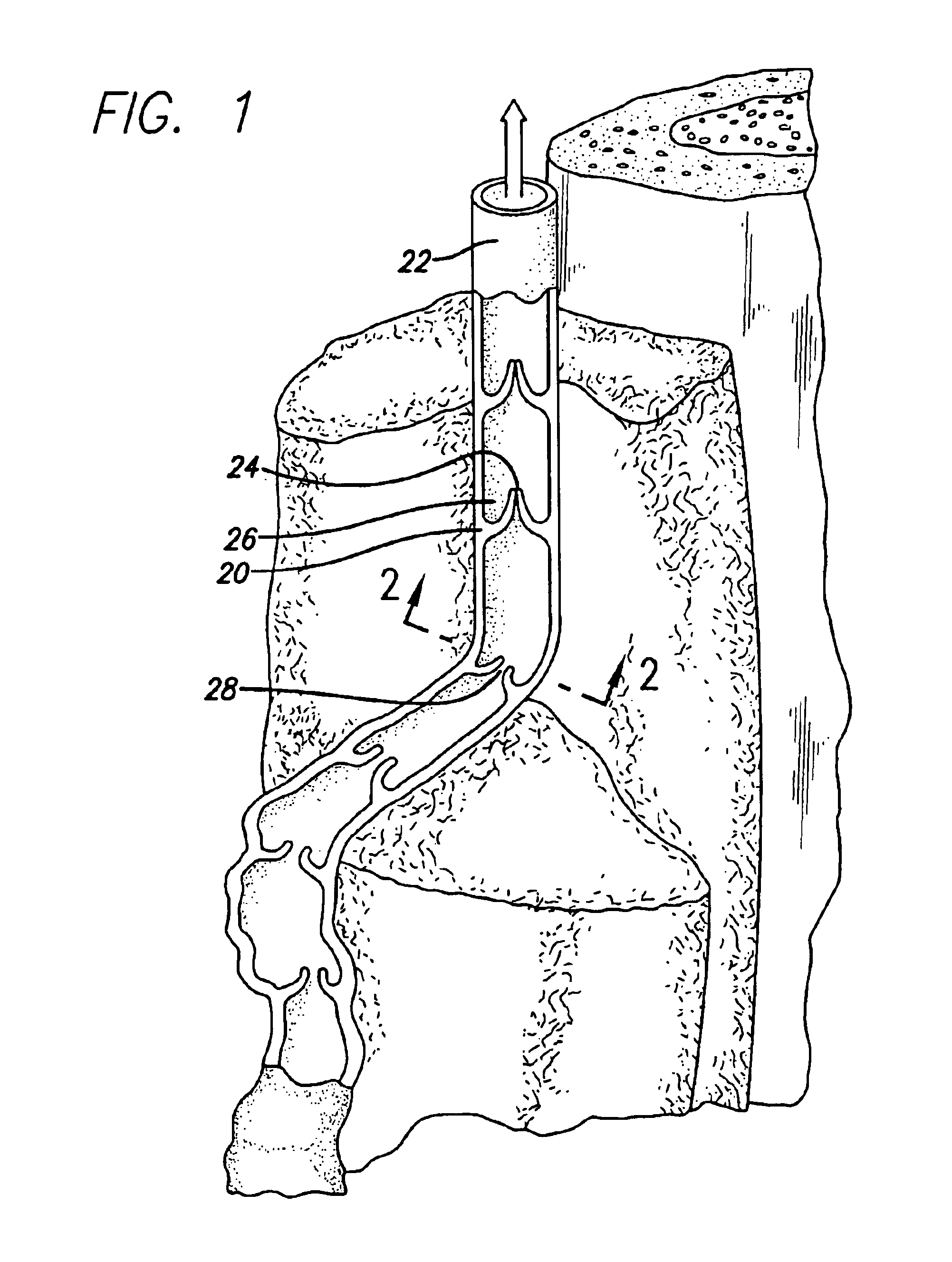 Apparatus for applying energy to biological tissue including the use of tumescent tissue compression