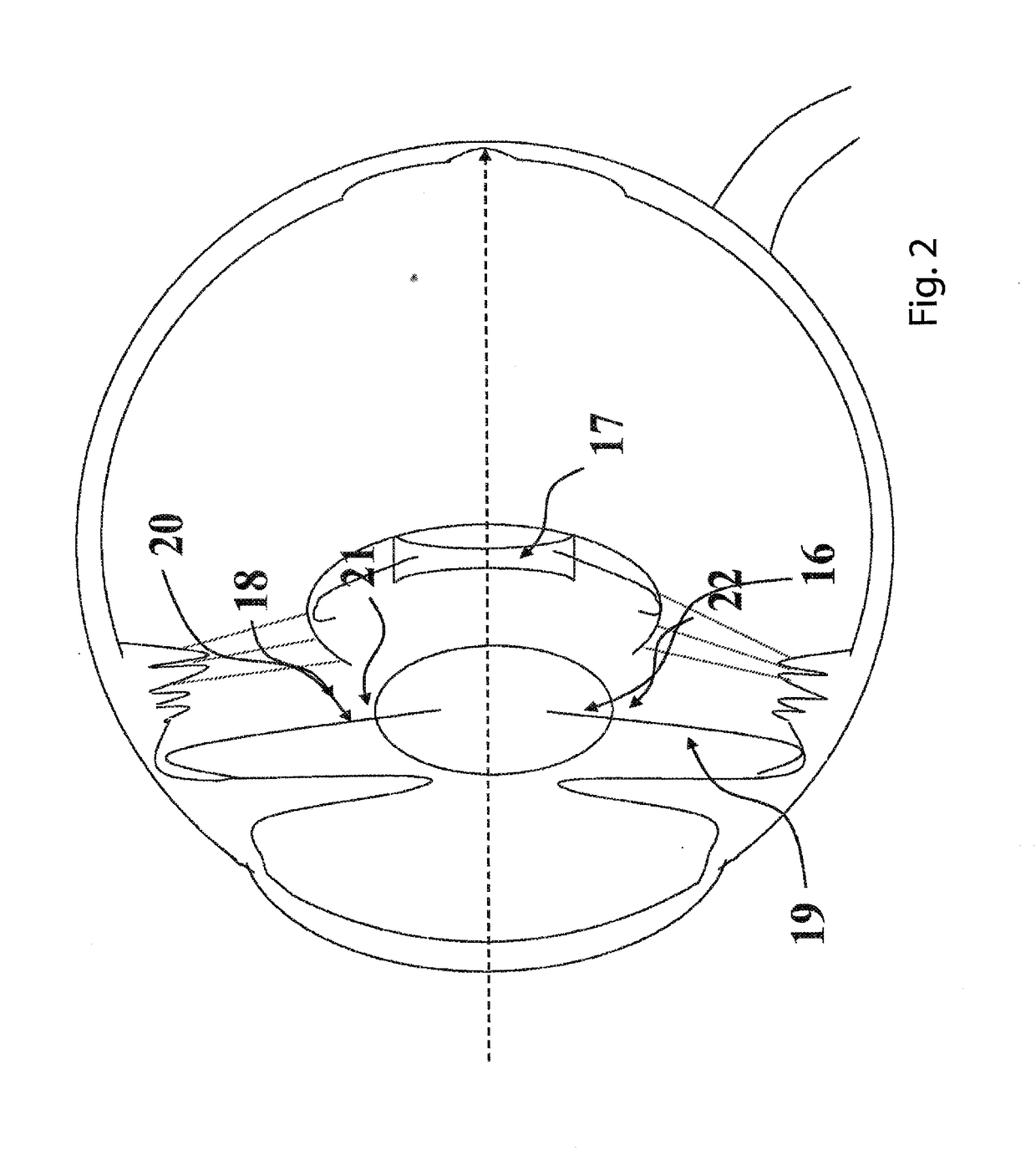 Intraocular lens system