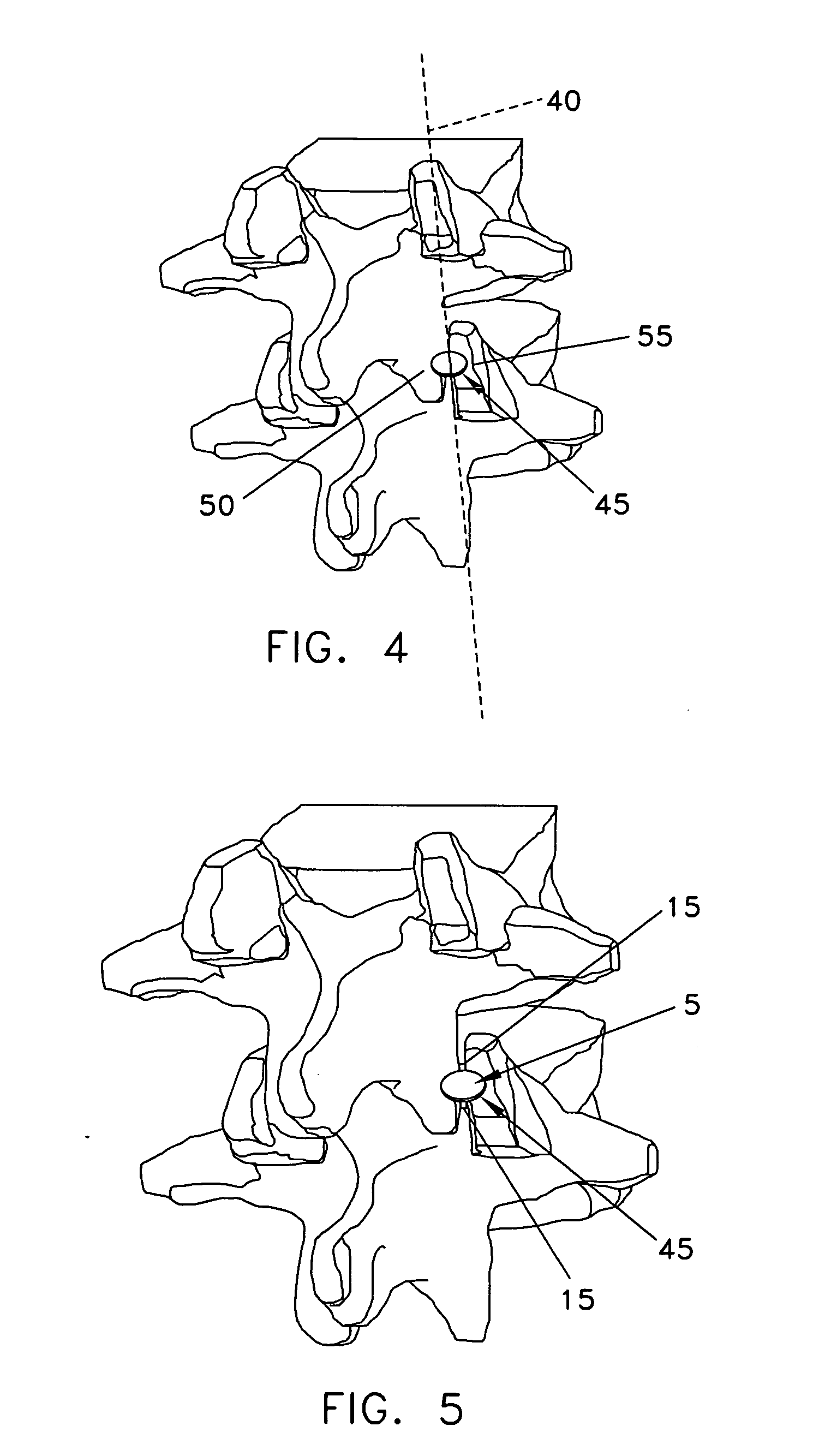 Method and apparatus for spinal facet fusion
