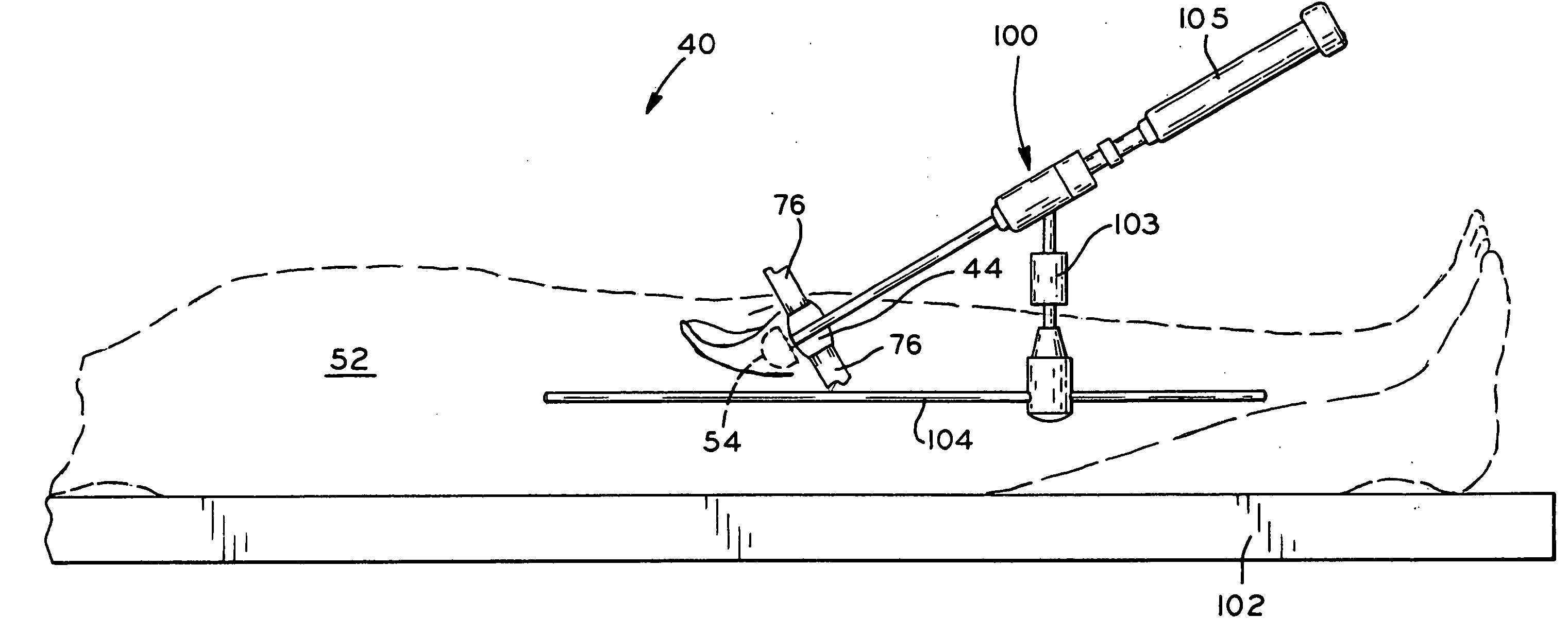 Method and apparatus for performing a minimally invasive total hip arthroplasty