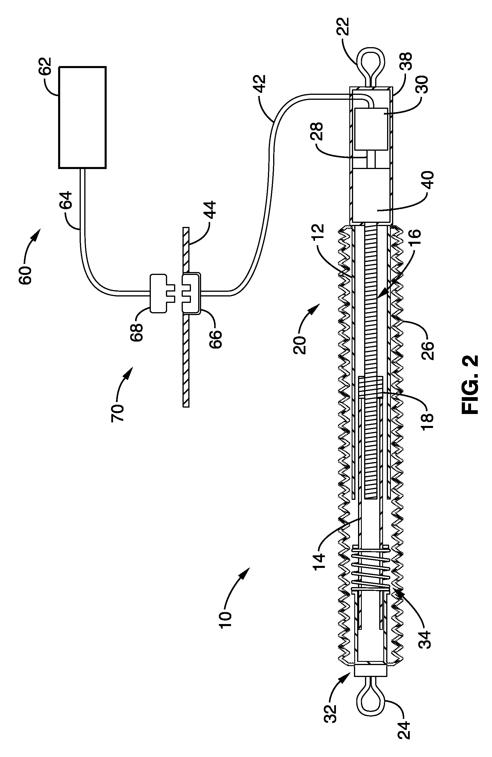 Apparatus and methods for alteration of anatomical features