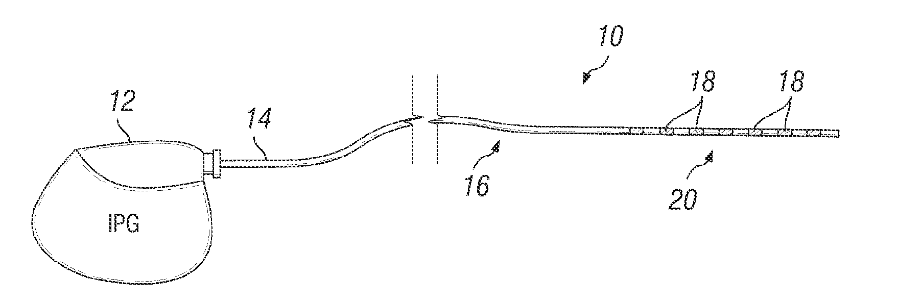 Method of using spinal cord stimulation to treat neurological disorders or conditions