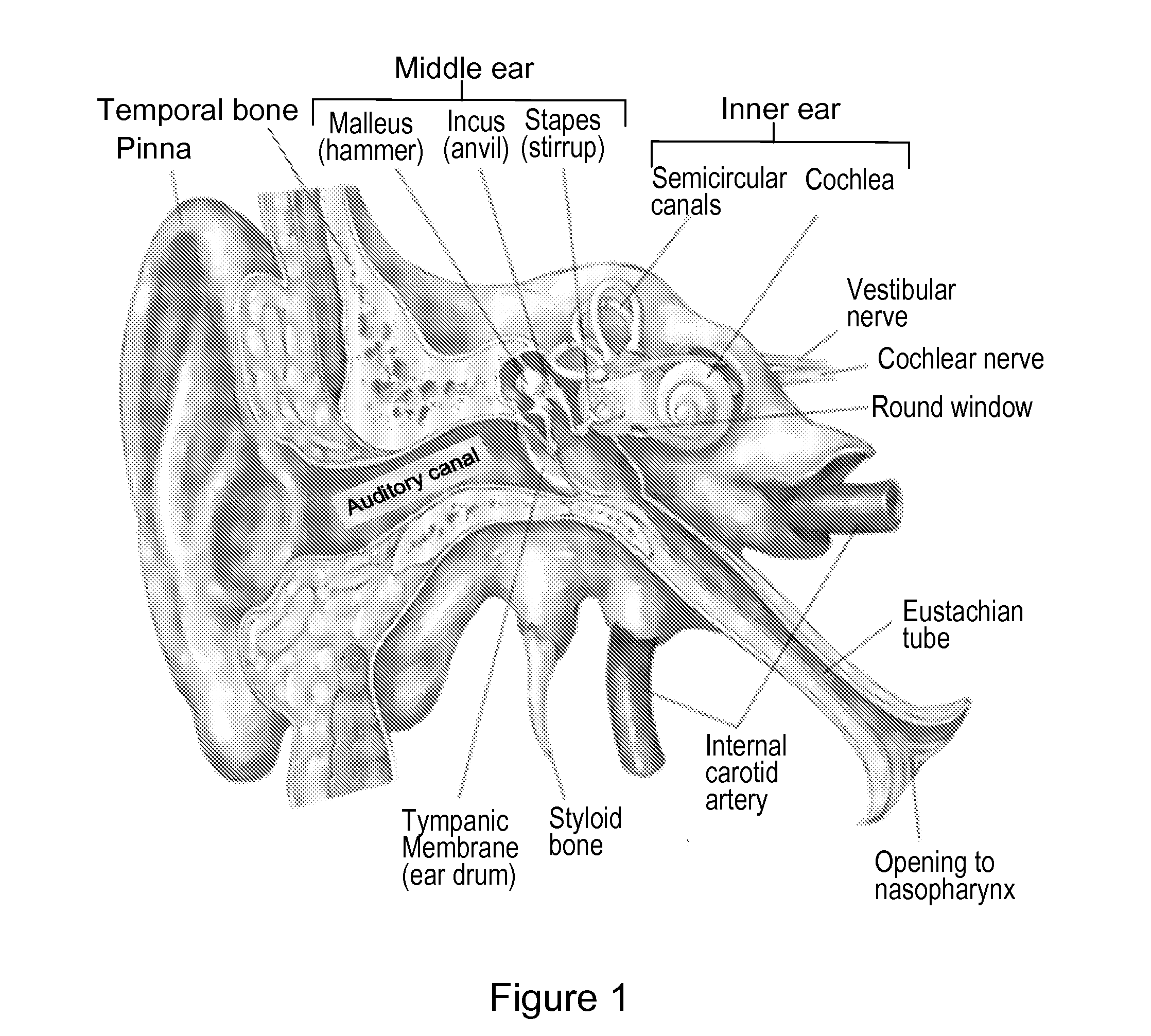 System and method to locally deliver therapeutic agent to inner ear