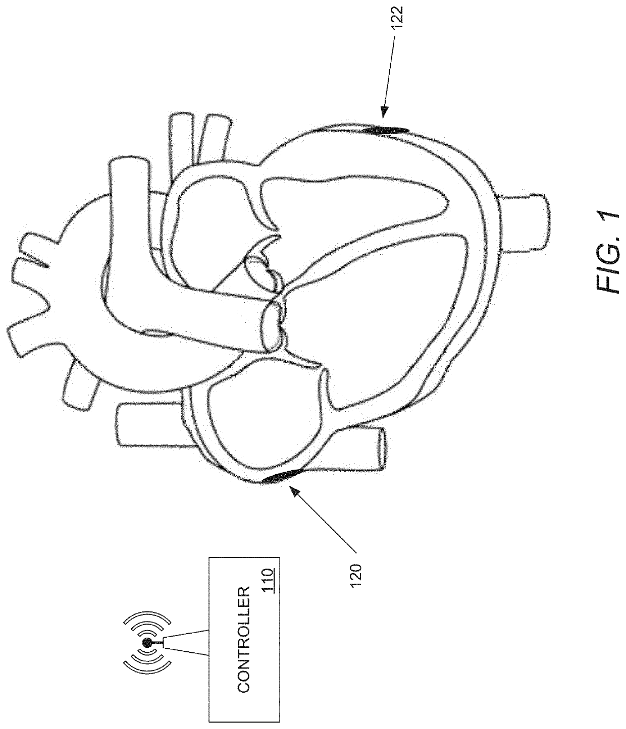 Systems and Methods for Controlling Wirelessly Powered Leadless Pacemakers