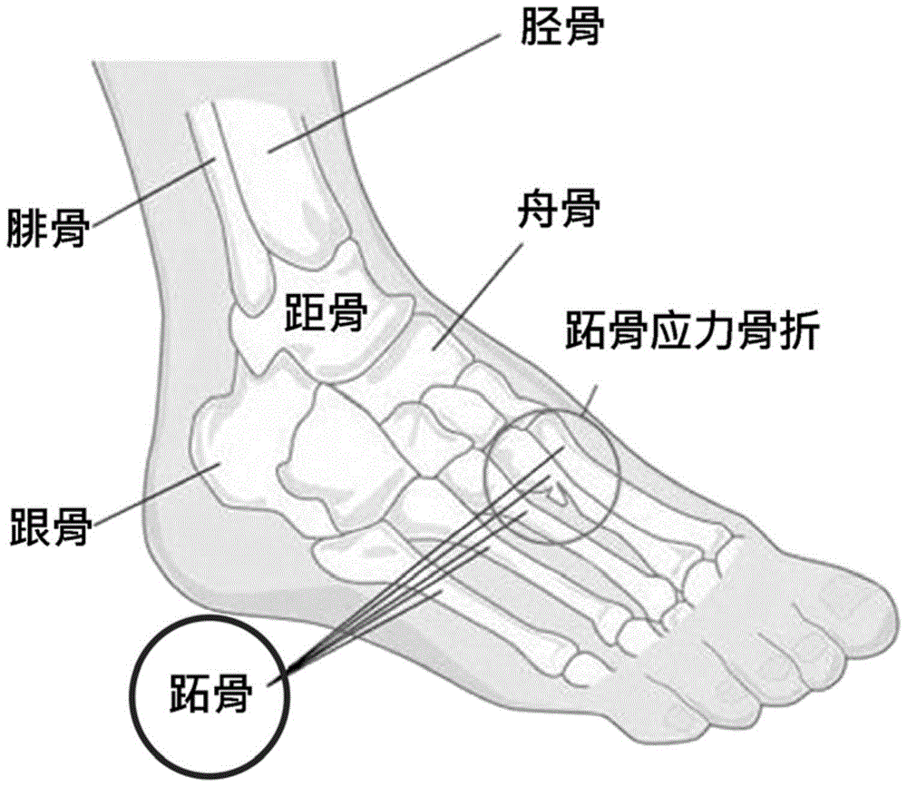 Adaptive insoles for posture correction