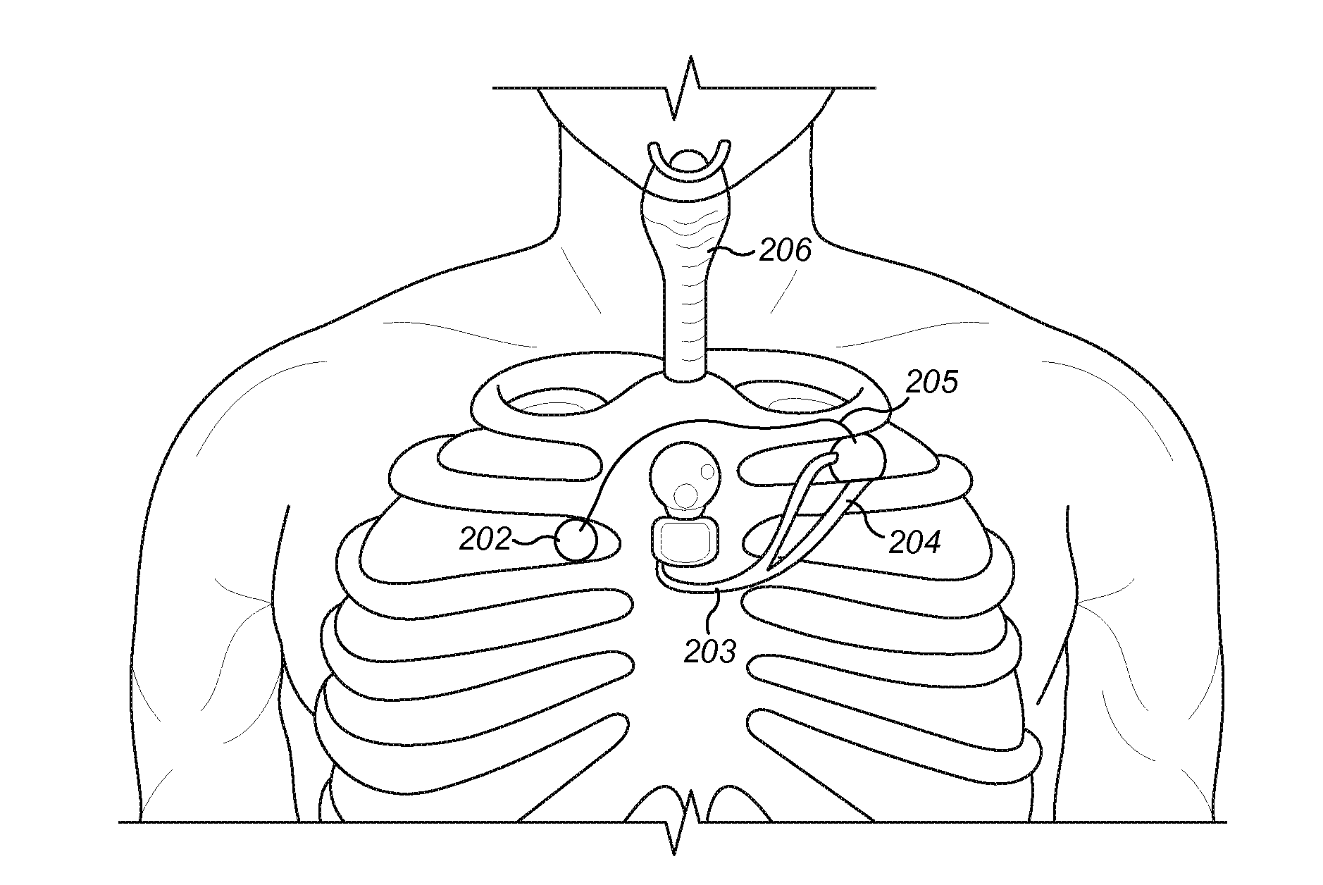 Acceleration Sensors For Recording Of Triggered Respiratory Signals In Neurostimulators