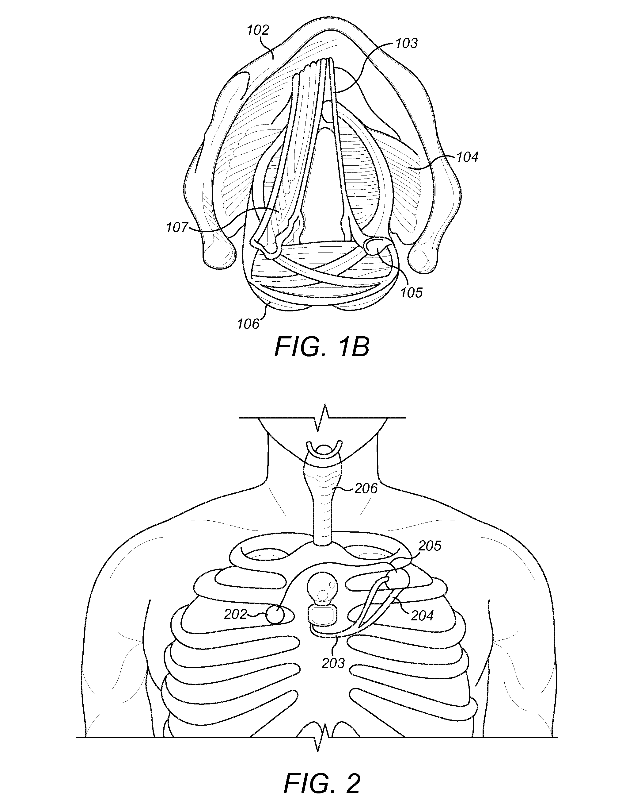 Acceleration Sensors For Recording Of Triggered Respiratory Signals In Neurostimulators