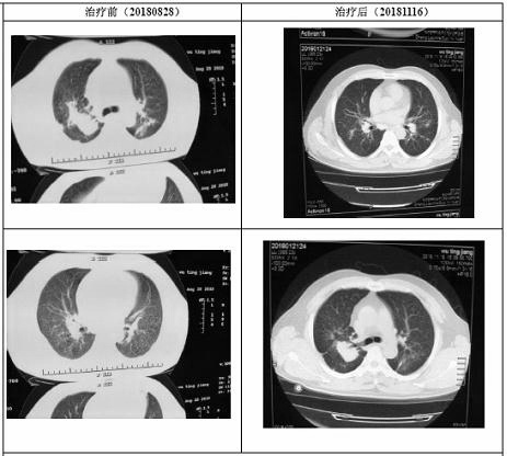 Tibetan medicine composition for treating pneumoconiosis and preparation method of Tibetan medicine composition