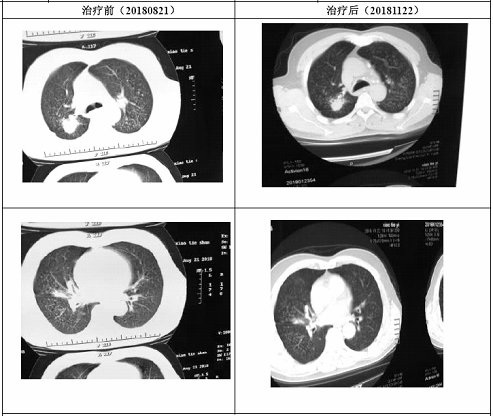 Tibetan medicine composition for treating pneumoconiosis and preparation method of Tibetan medicine composition