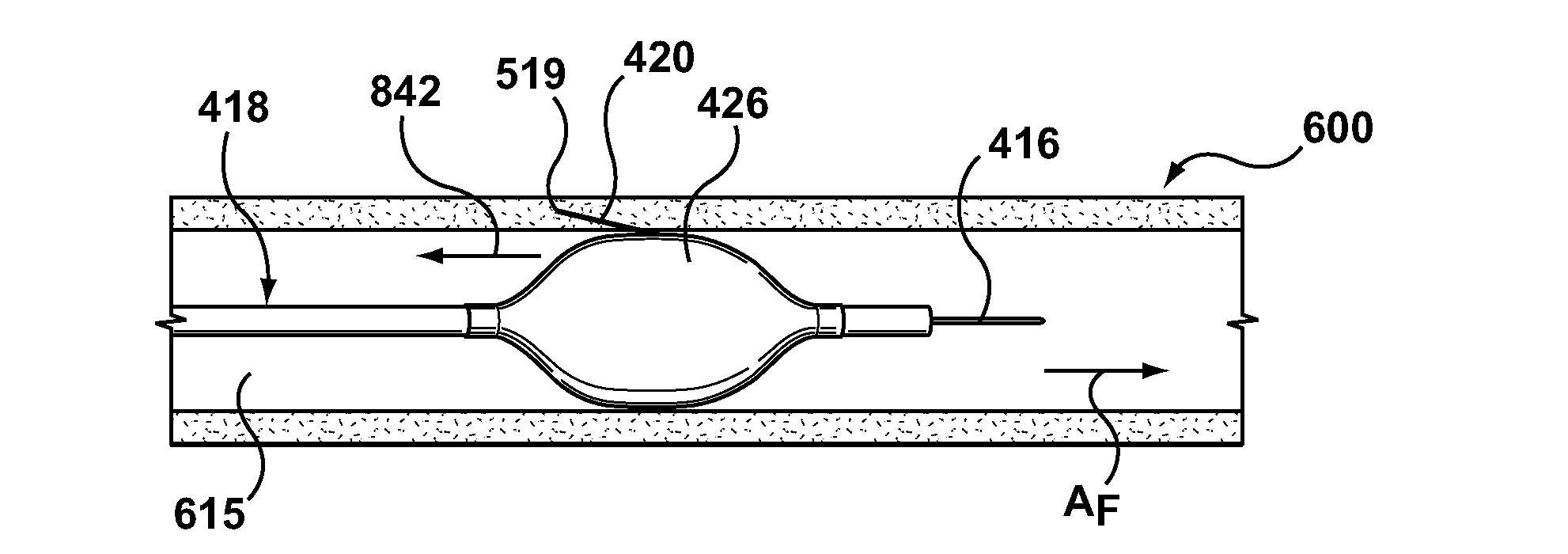 Percutaneous methods and apparatus for creating native tissue venous valves