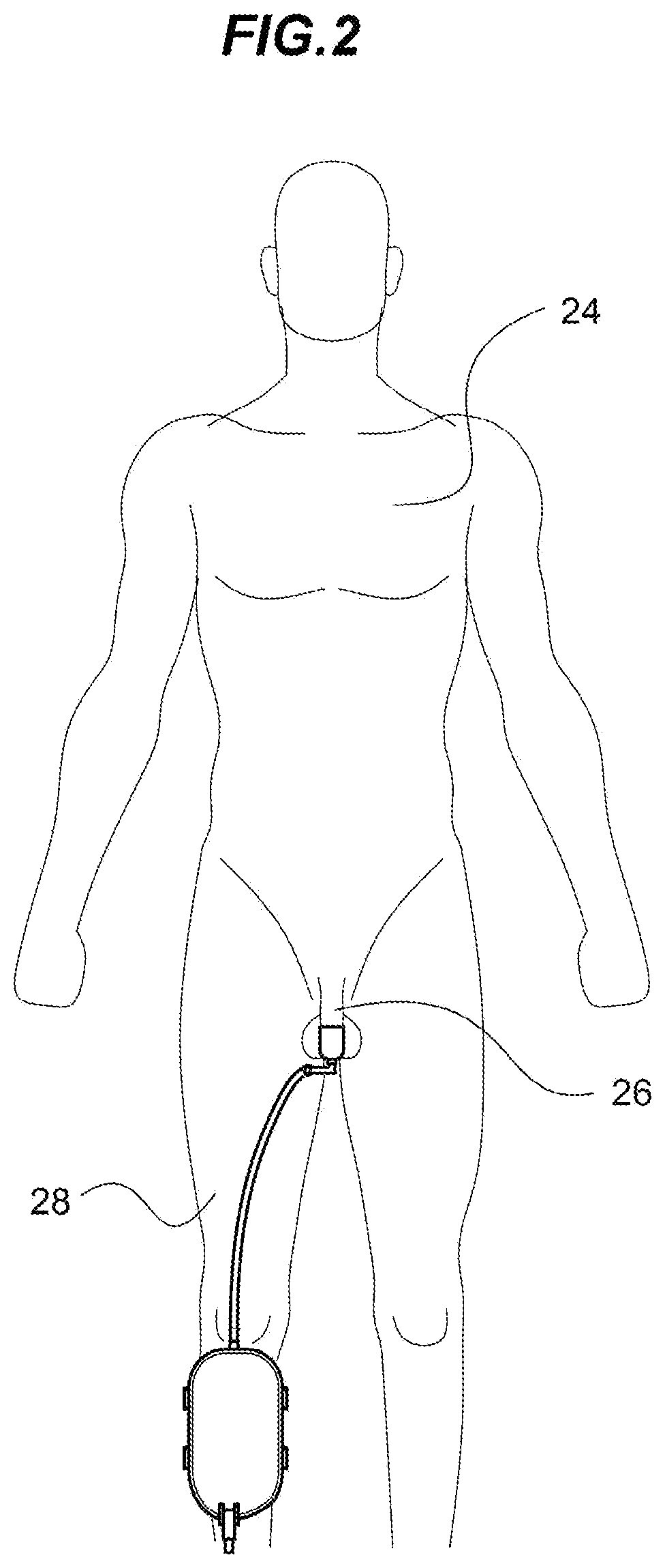 Reusable penile attachment for urinary incontinence which uses pressure differential as means of attachment