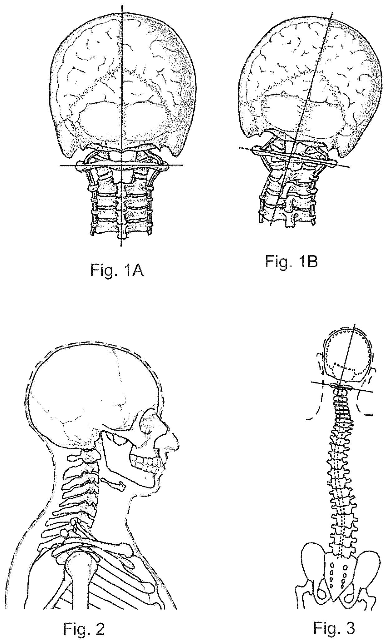 User-customizable orthopedic alignment device with alignment gap