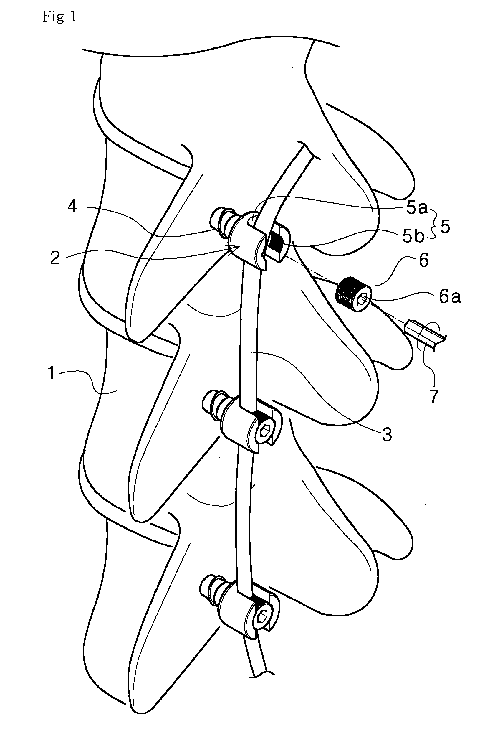 Pedicle Screw and Device for Injecting Bone Cement into Bone