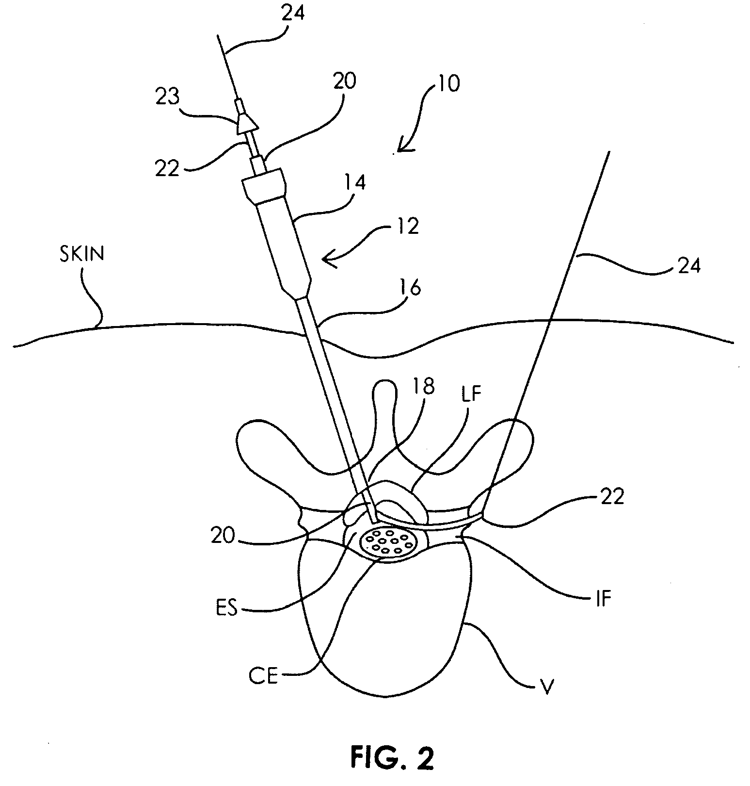 Spinal access system and method
