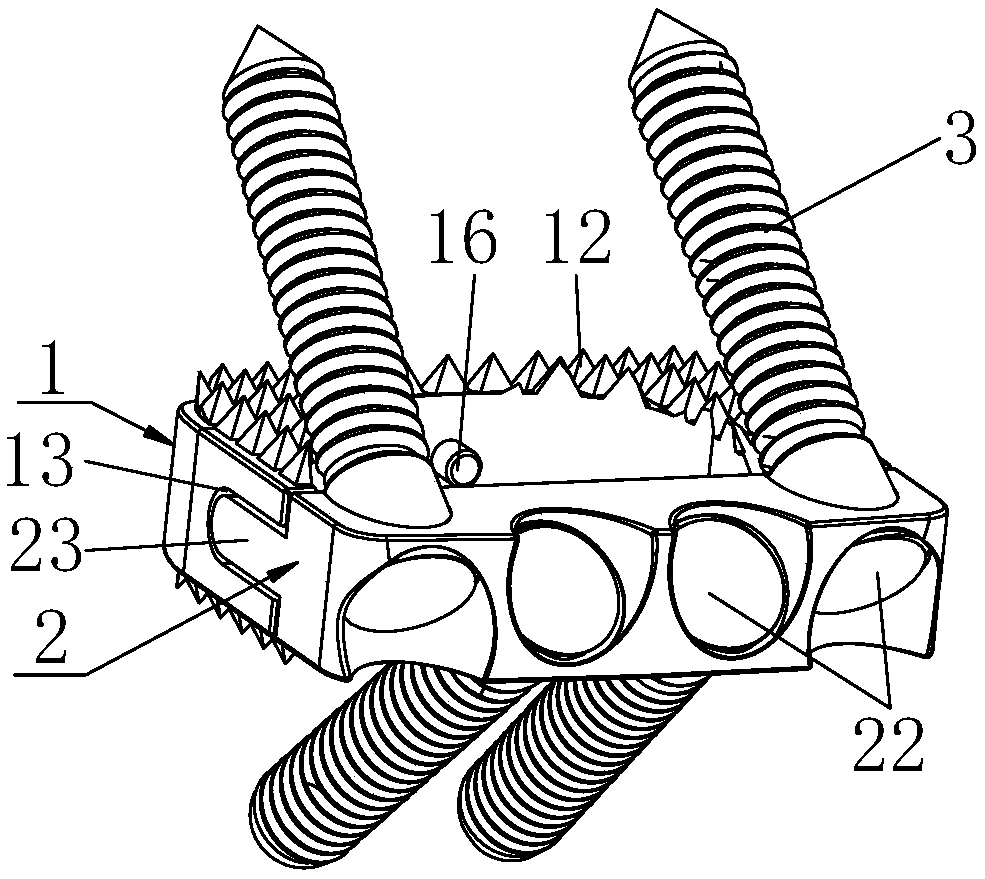 Zero-incisure interbody fusion cage for anterior cervical vertebra