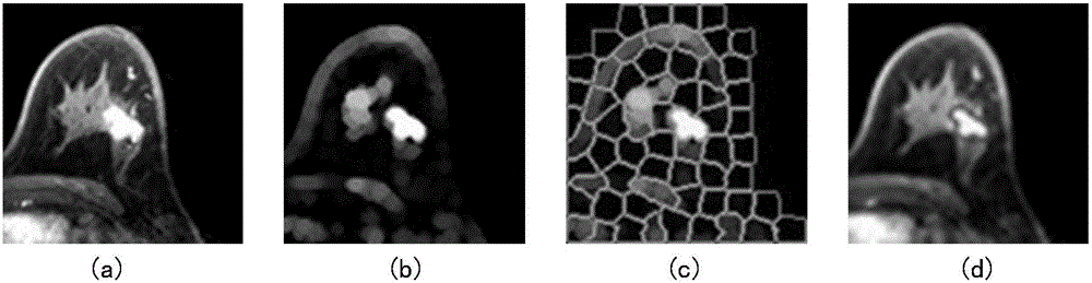 Automatic segmentation method for breast MRI focus based on Inter-frame correlation
