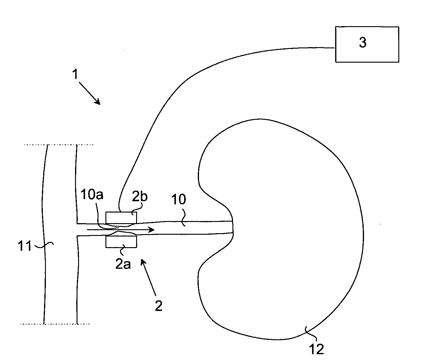System and method for thermal treatment of hypertension, hypotension or aneurysm