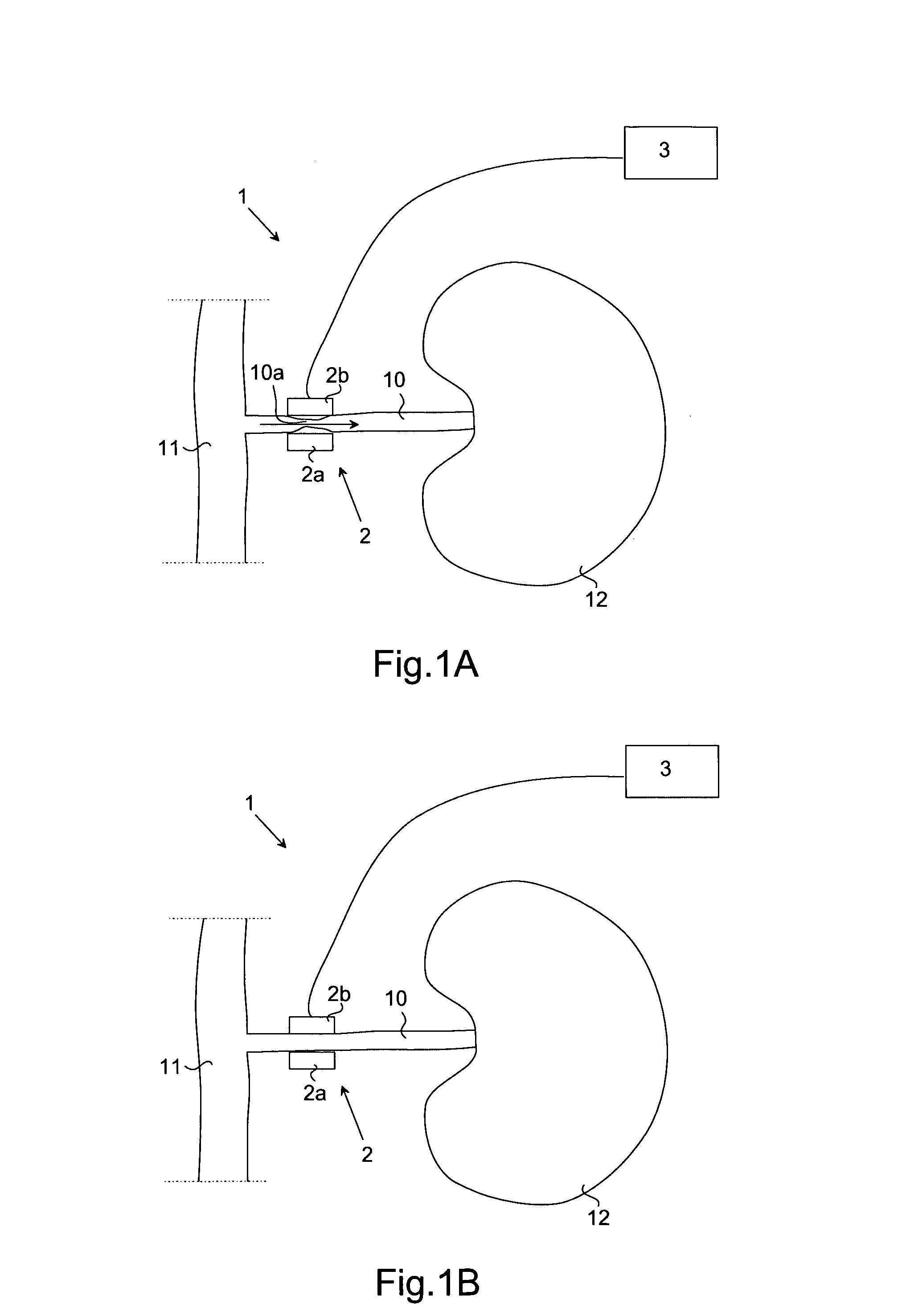 System and method for thermal treatment of hypertension, hypotension or aneurysm