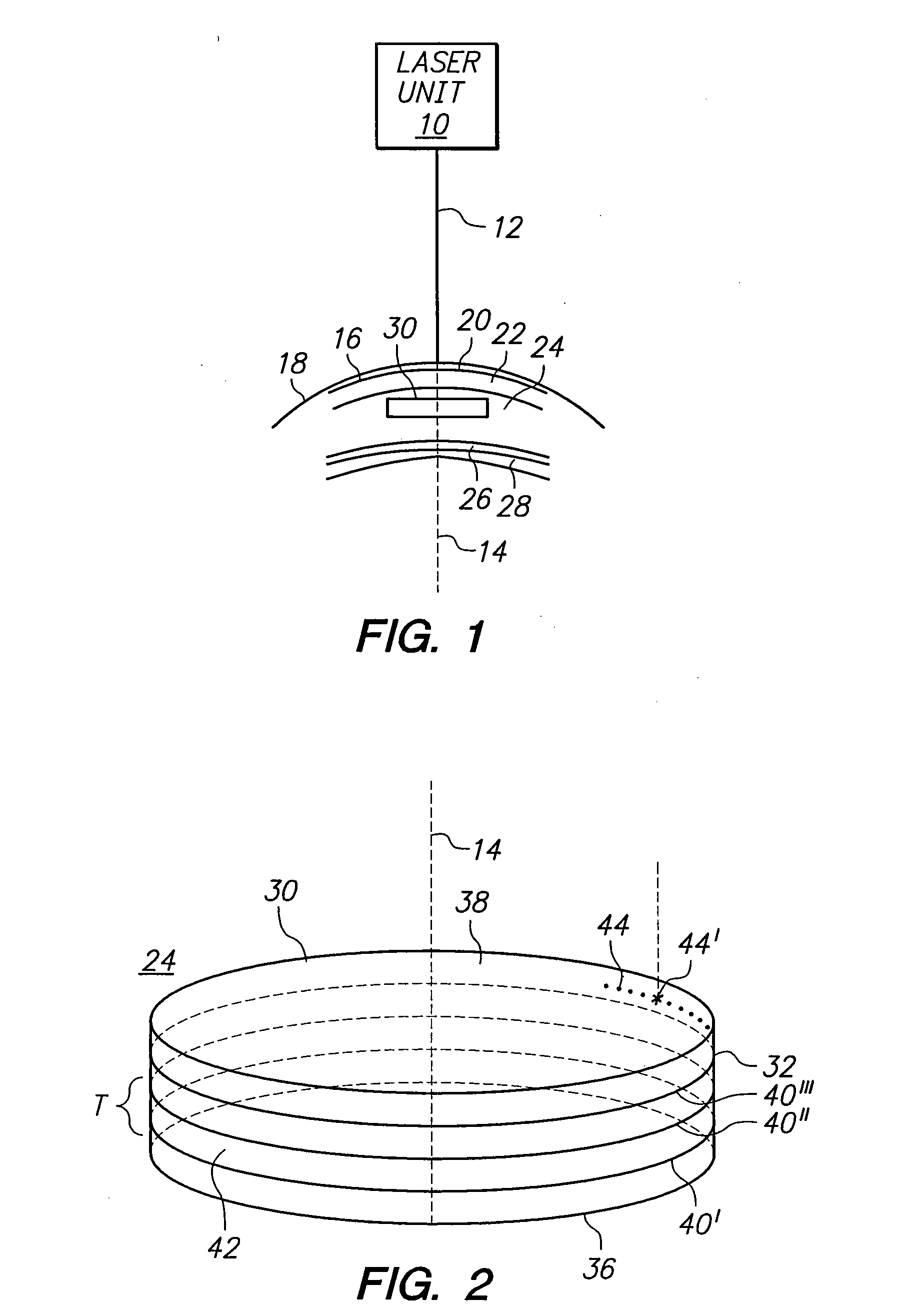 Method for harvesting corneal donor plugs for use in keratophakia procedures