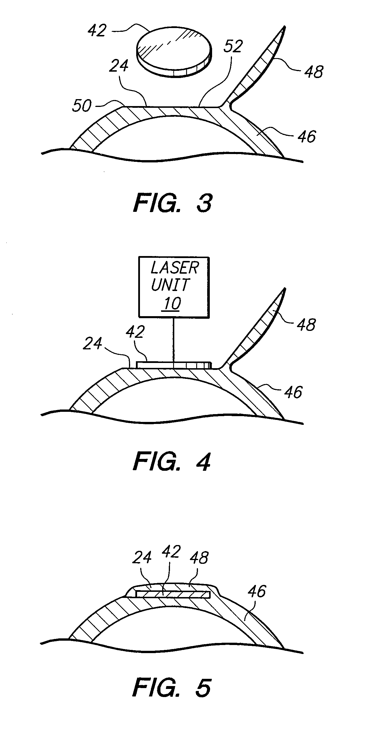 Method for harvesting corneal donor plugs for use in keratophakia procedures