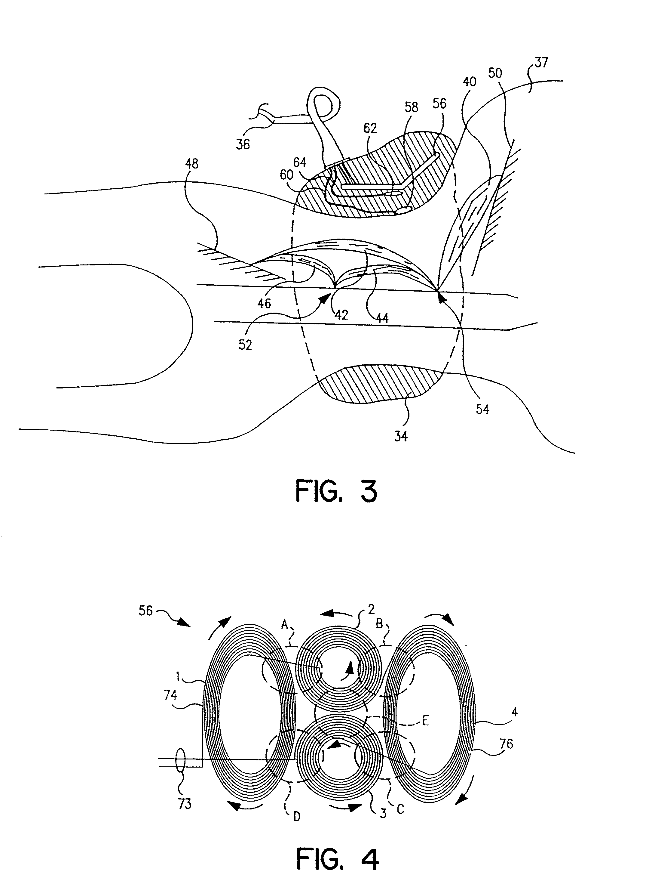 Muscle stimulating device and method for diagnosing and treating a breathing disorder