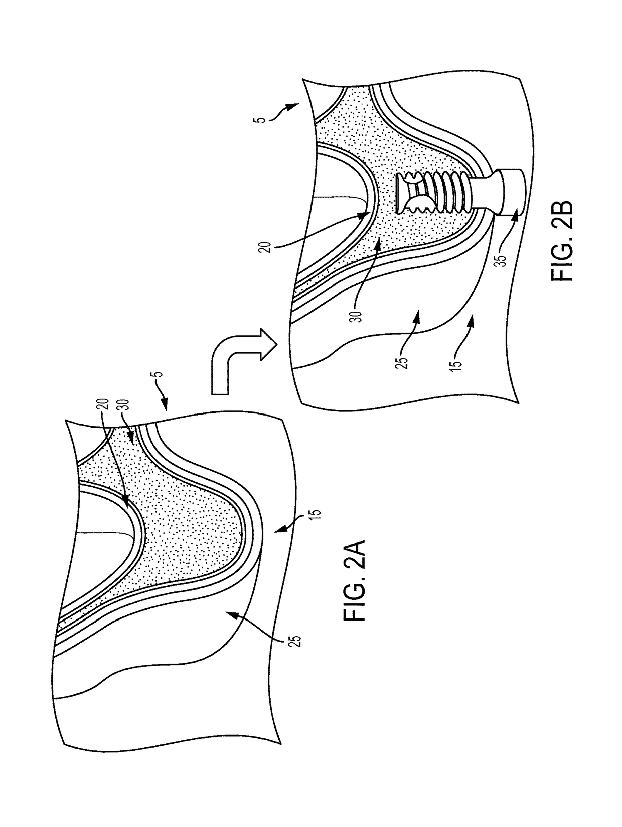 Method for conducting a guided sinus lift procedure