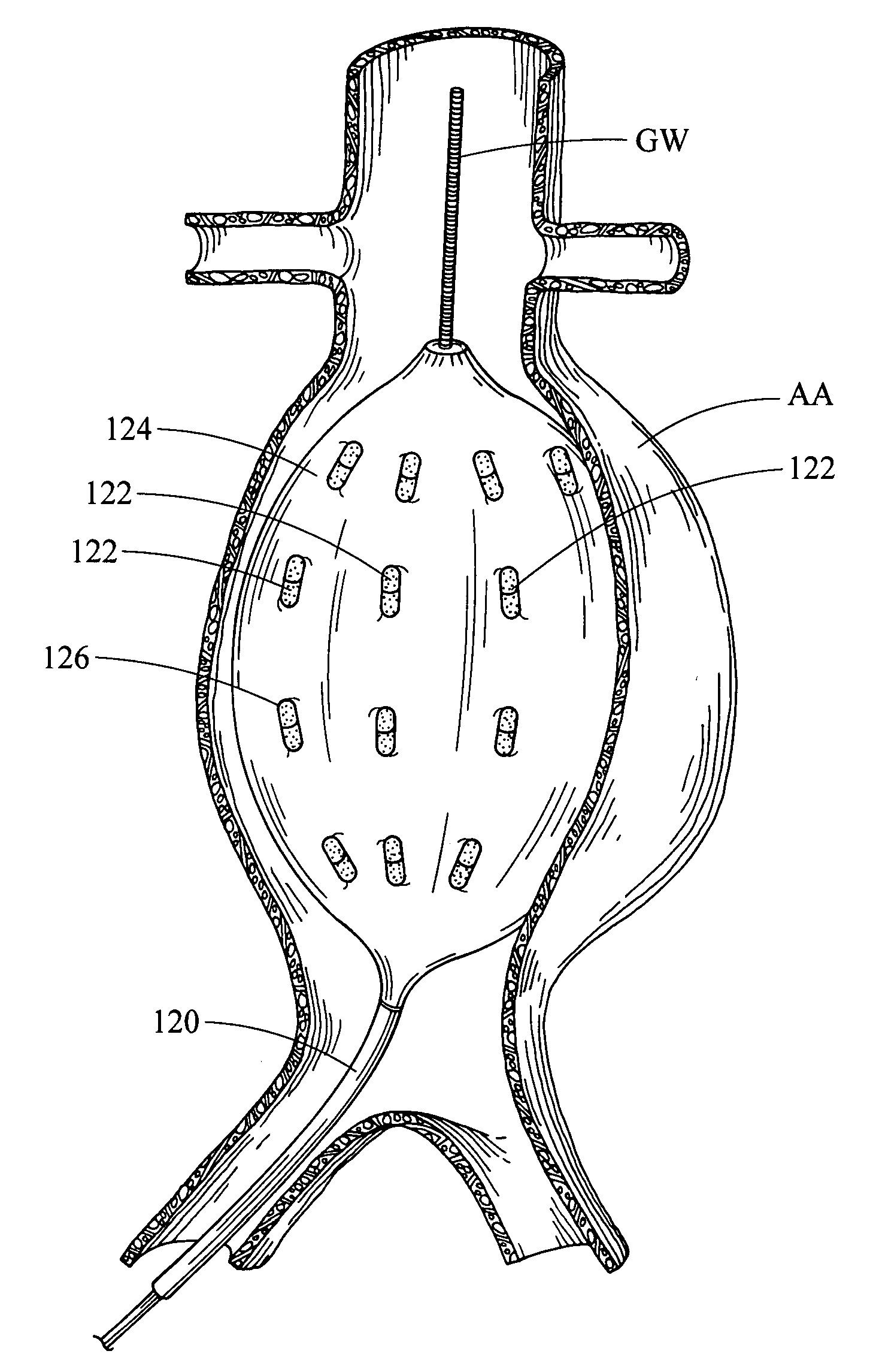 Endoluminal medical device for local delivery of cathepsin inhibitors, method of making and treating